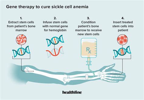 Promising new gene therapies for sickle cell are out of reach in countries where they’re needed most